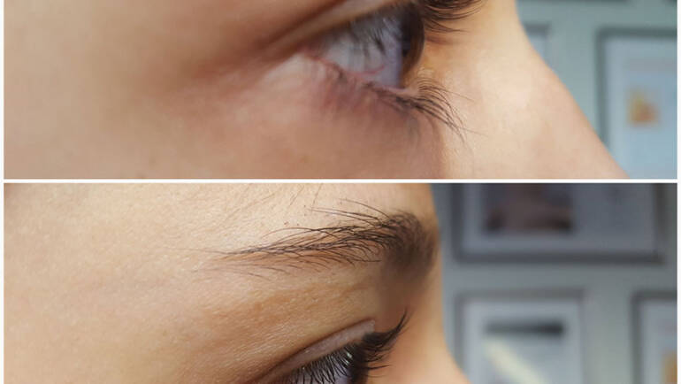 Lashlifting vorher und nachher
